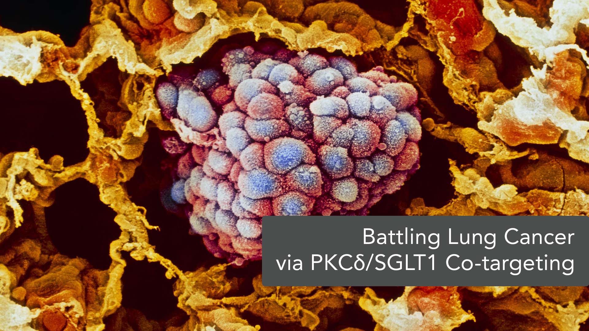 PKCδ/SGLT1 Co-targeting for Improved Therapeutic Efficacy of EGFR TKIs in NSCLC Patients