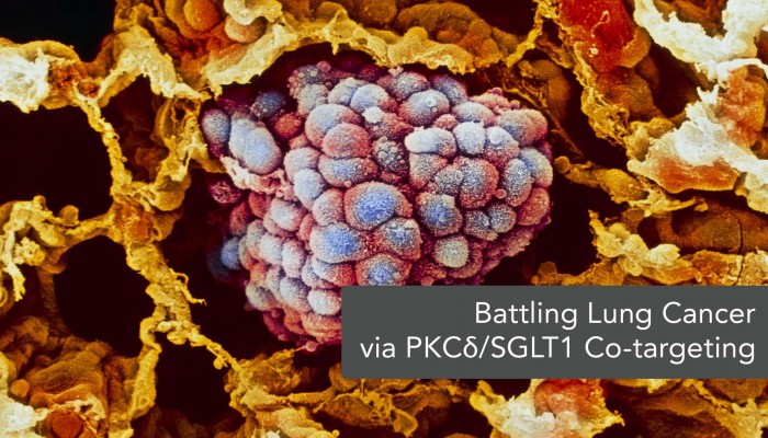 PKCδ/SGLT1 Co-targeting for Improved Therapeutic Efficacy of EGFR TKIs in NSCLC Patients