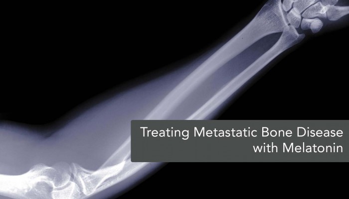 Osteoblastic Prostate Cancer Migration Suppressed by Melatonin